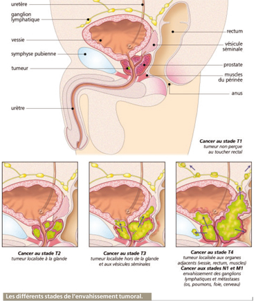 cancer prostate