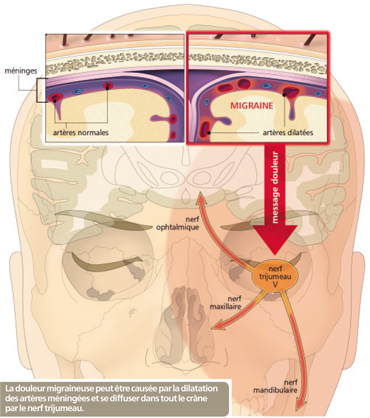 pourquoi la migraine