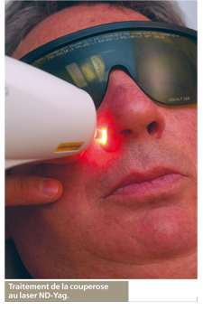 laser